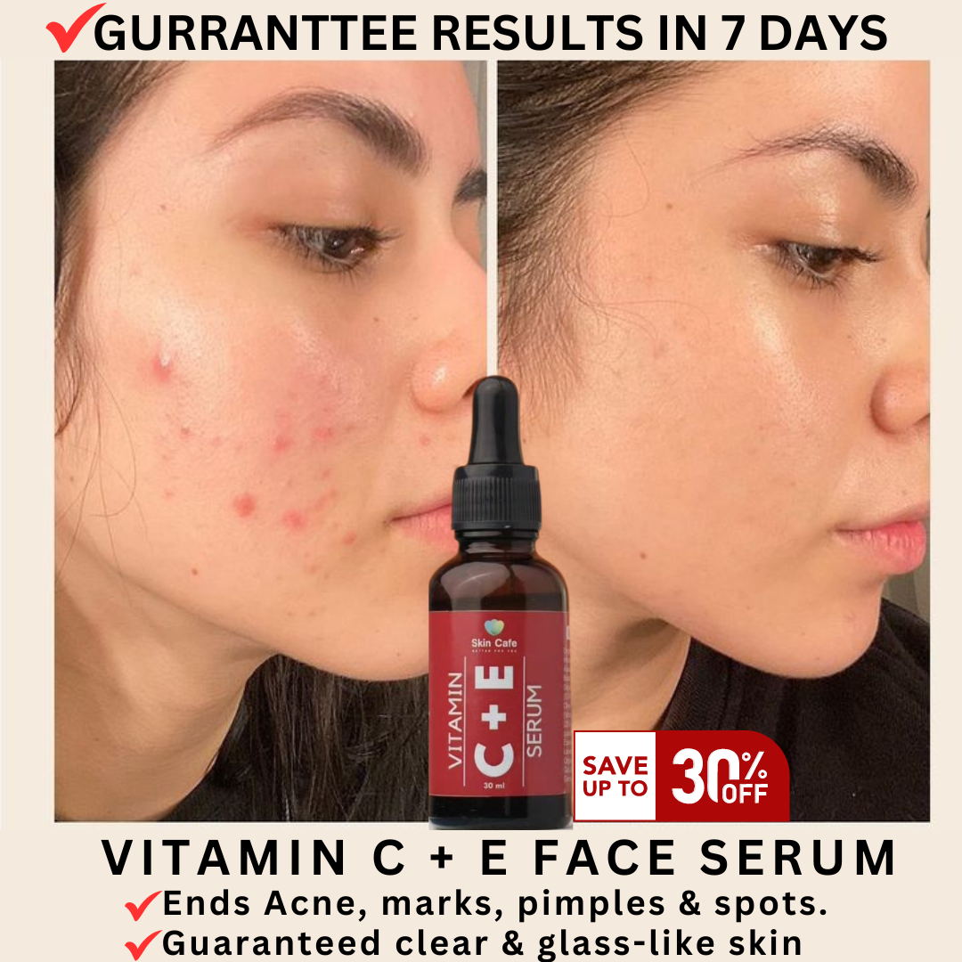 ANTI ACNE  SERUM REMOVE ACNE IN 3 DAYS !