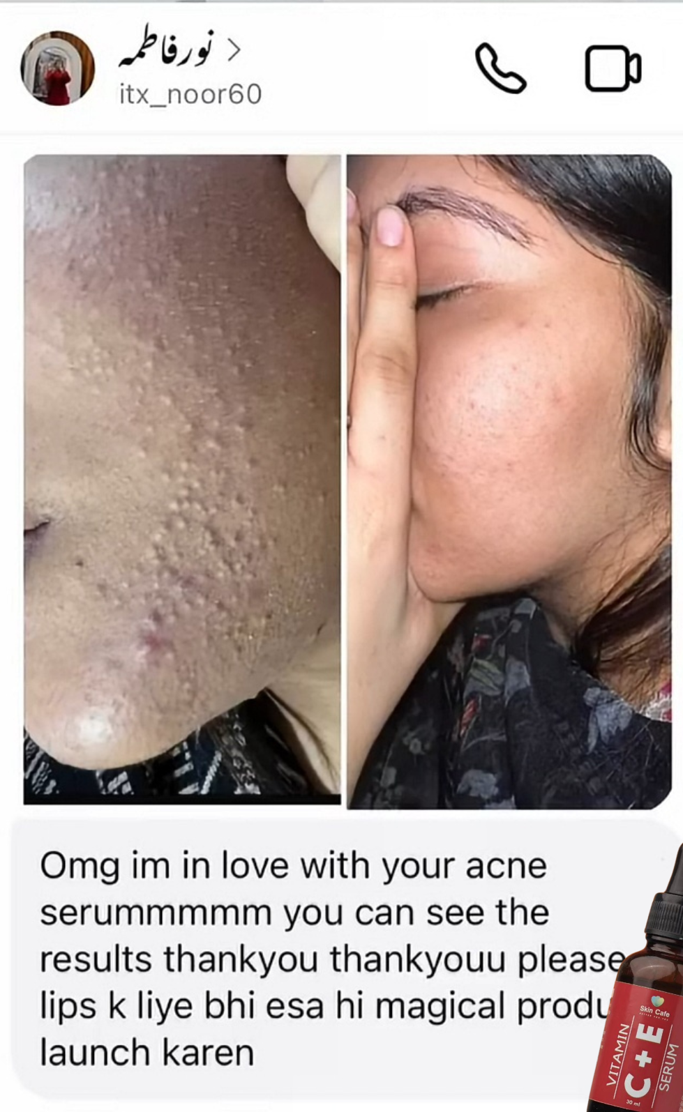 ANTI ACNE  SERUM REMOVE ACNE IN 3 DAYS !