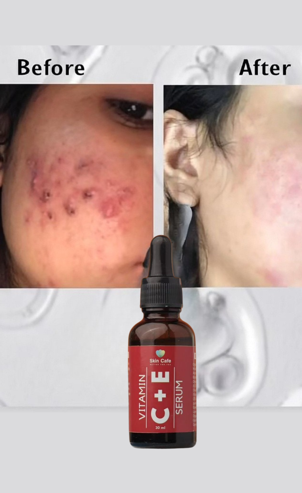ANTI ACNE  SERUM REMOVE ACNE IN 3 DAYS !
