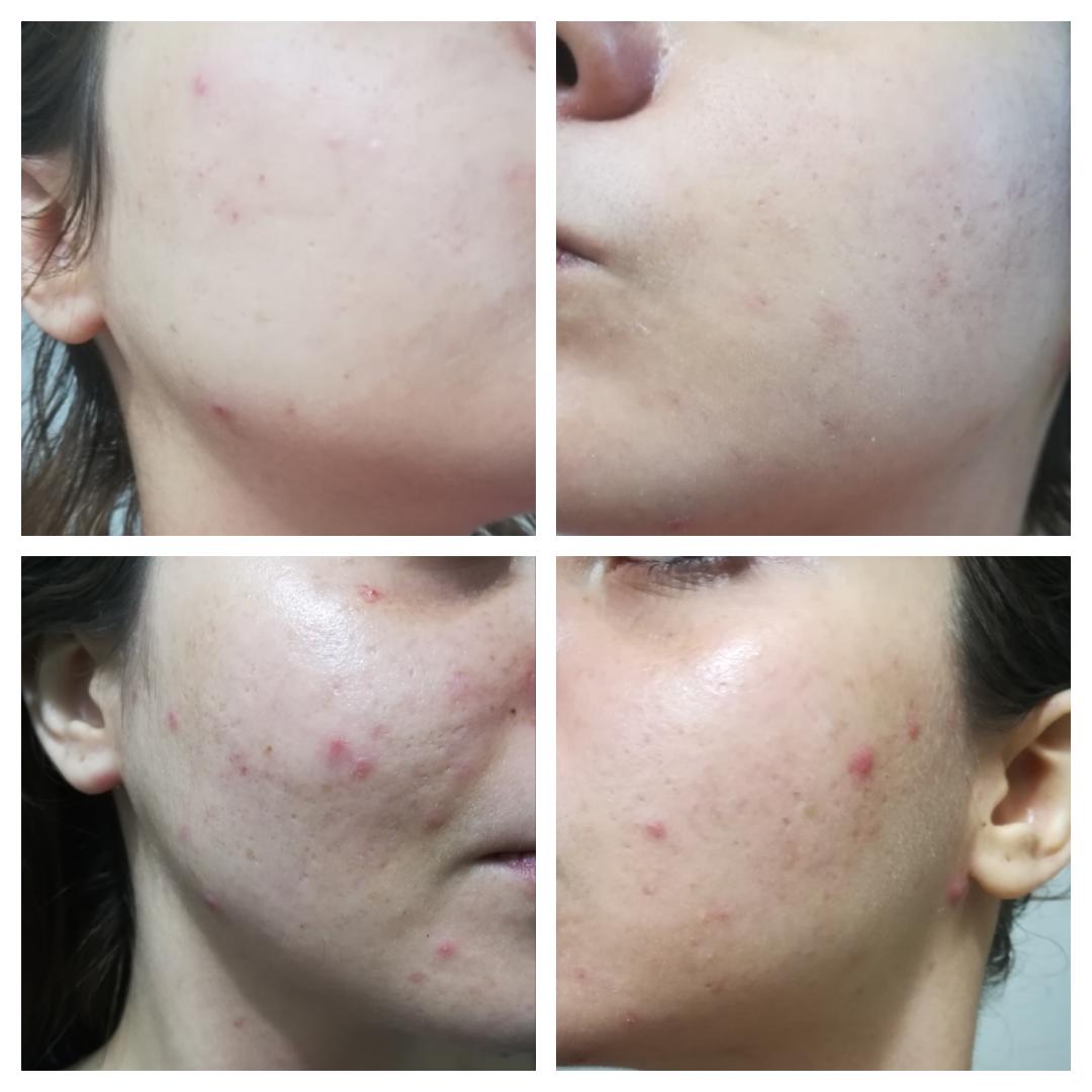 ANTI ACNE  SERUM REMOVE ACNE IN 3 DAYS !