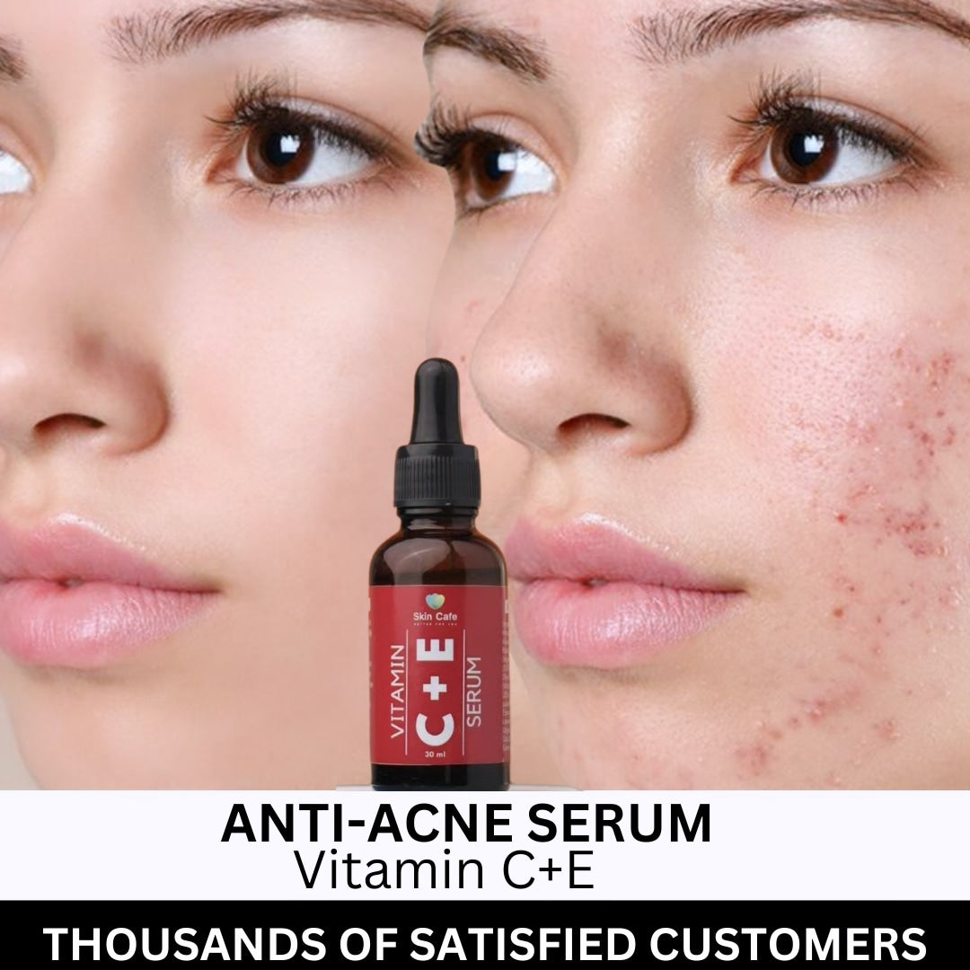 ANTI ACNE BUNDLE (REMOVE ACNE WIITHIN 7 DAYS )