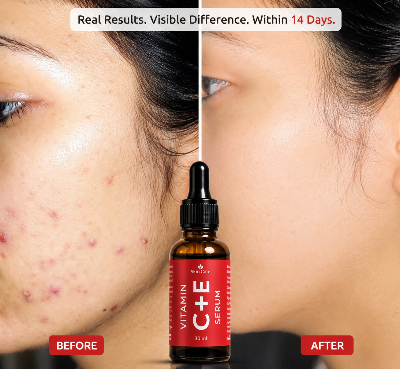 ANTI ACNE  SERUM REMOVE ACNE IN 3 DAYS !