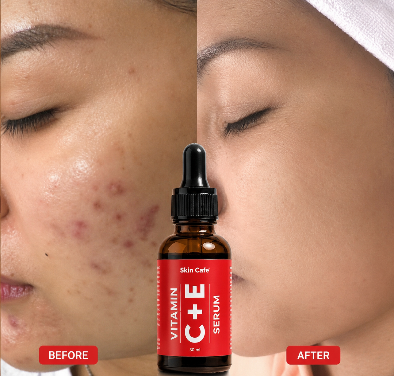 ANTI ACNE  SERUM REMOVE ACNE IN 3 DAYS !