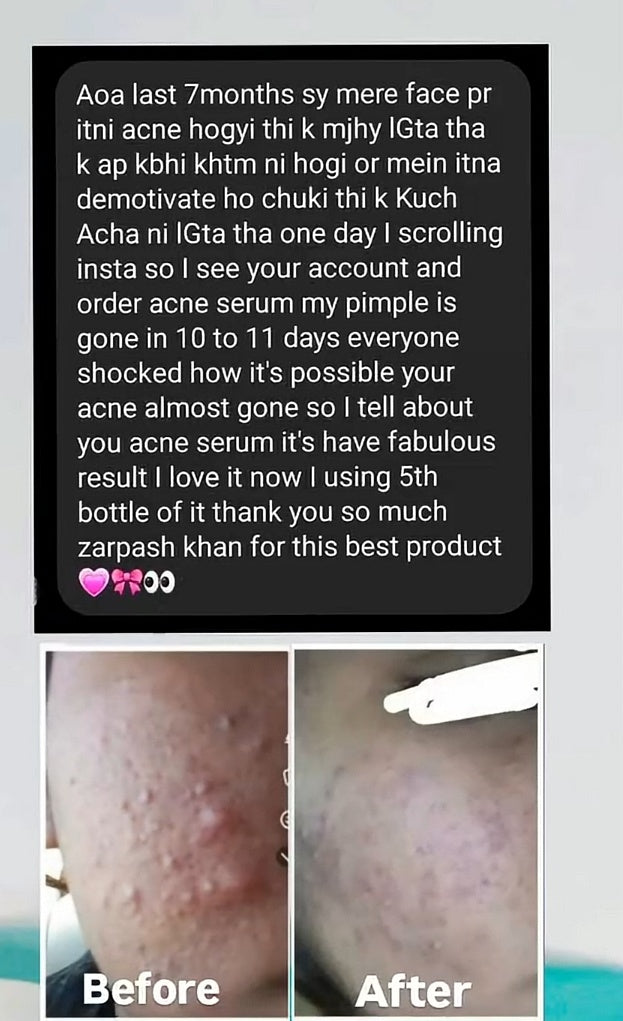 ANTI ACNE  SERUM REMOVE ACNE IN 3 DAYS !