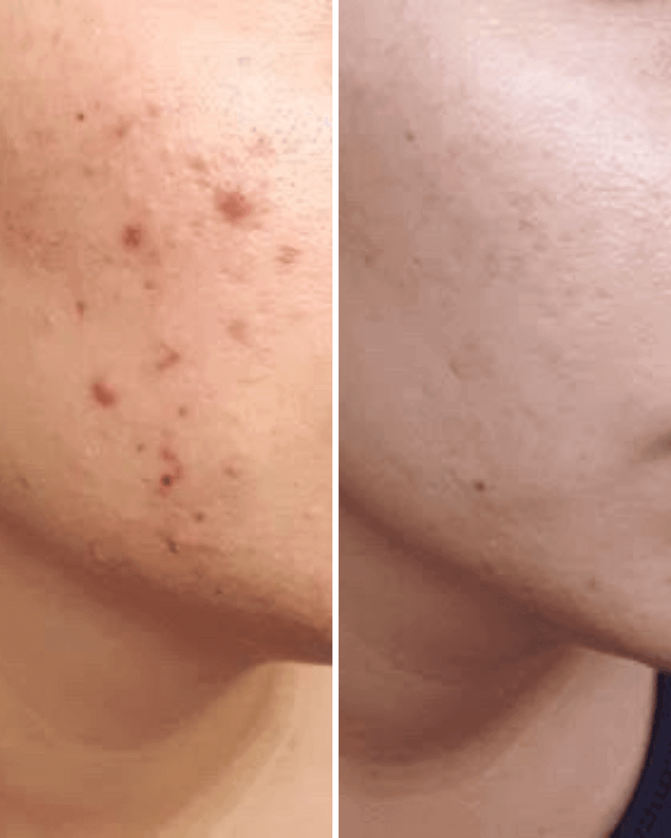 ANTI ACNE BUNDLE (REMOVE ACNE WIITHIN 7 DAYS )