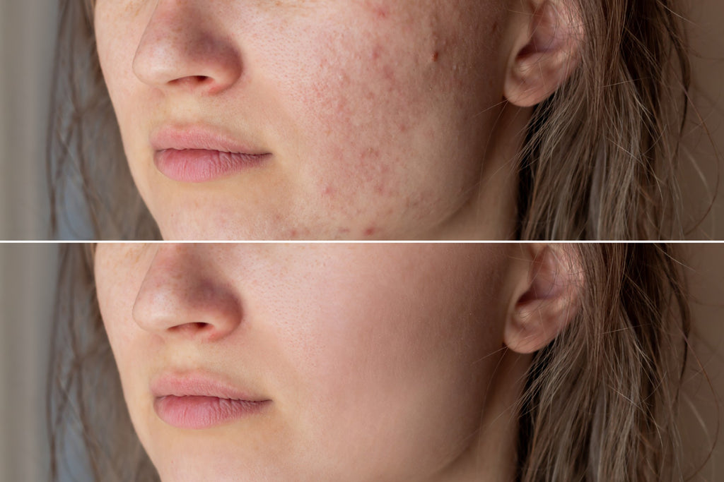 ANTI ACNE  SERUM REMOVE ACNE IN 3 DAYS !